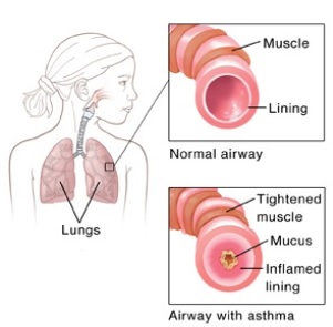Asthma Treatment in Homeopathy