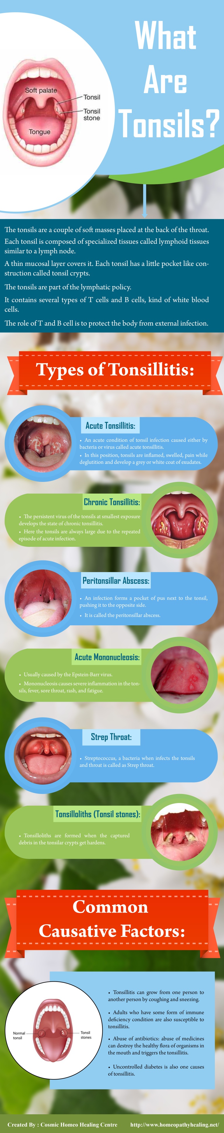 Types of Tonsillitis